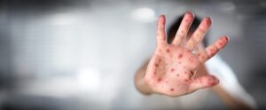 Measles deaths first reported in West Texas